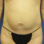 Tummy Tuck Before & After Patient #2604