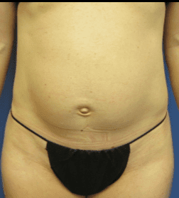 Tummy Tuck Before & After Patient #2604
