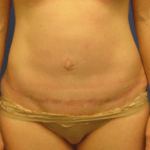 Tummy Tuck Before & After Patient #2604