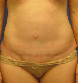 Tummy Tuck Before & After Patient #2604