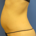 Tummy Tuck Before & After Patient #2604
