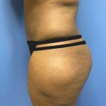 Tummy Tuck Before & After Patient #2609