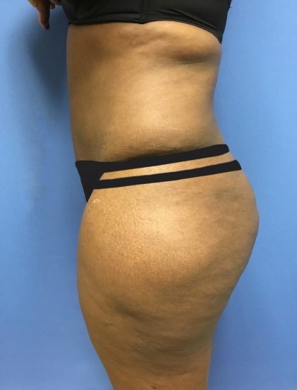 Tummy Tuck Before & After Patient #2609