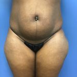 Tummy Tuck Before & After Patient #2609
