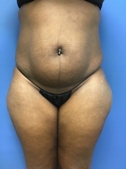 Tummy Tuck Before & After Patient #2609