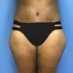 Tummy Tuck Before & After Patient #2609