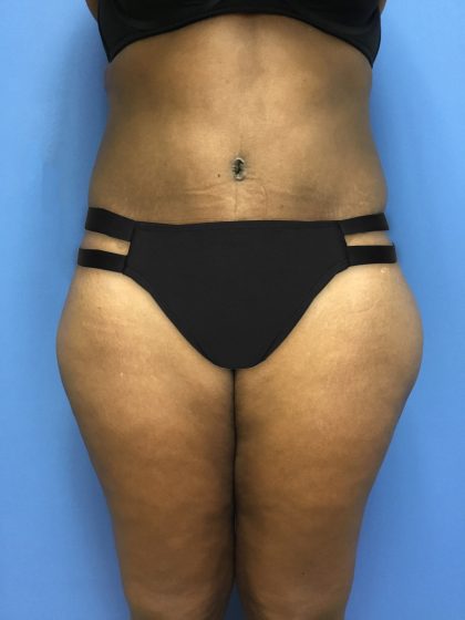 Tummy Tuck Before & After Patient #2609