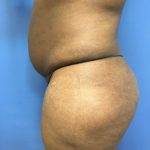 Tummy Tuck Before & After Patient #2609
