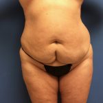Tummy Tuck Before & After Patient #2614