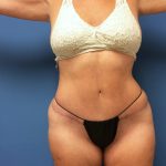 Tummy Tuck Before & After Patient #2614