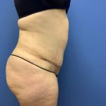 Tummy Tuck Before & After Patient #2619