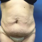Tummy Tuck Before & After Patient #2619