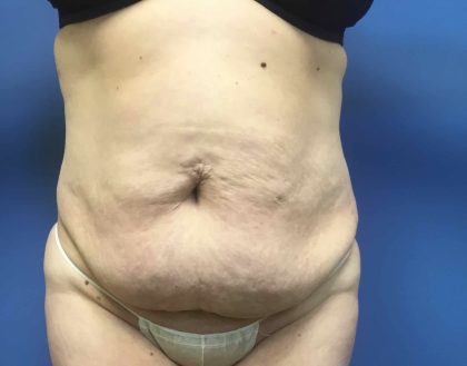 Tummy Tuck Before & After Patient #2619