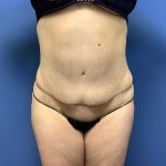 Tummy Tuck Before & After Patient #2619