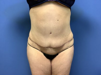 Tummy Tuck Before & After Patient #2619