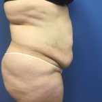 Tummy Tuck Before & After Patient #2619