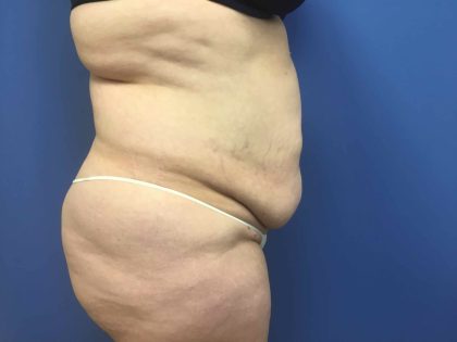 Tummy Tuck Before & After Patient #2619