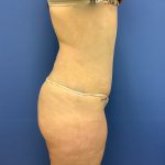 Tummy Tuck Before & After Patient #2624