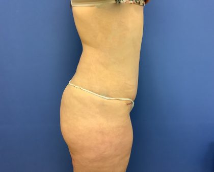 Tummy Tuck Before & After Patient #2624