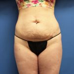 Tummy Tuck Before & After Patient #2624