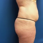 Tummy Tuck Before & After Patient #2624