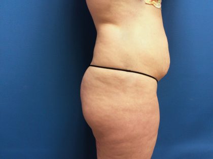 Tummy Tuck Before & After Patient #2624