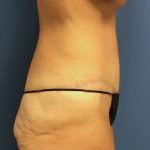 Tummy Tuck Before & After Patient #2629