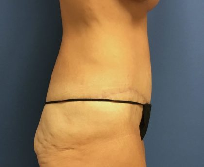 Tummy Tuck Before & After Patient #2629