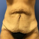 Tummy Tuck Before & After Patient #2629