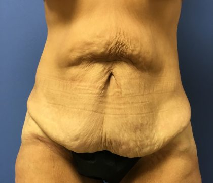 Tummy Tuck Before & After Patient #2629