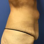Tummy Tuck Before & After Patient #2629