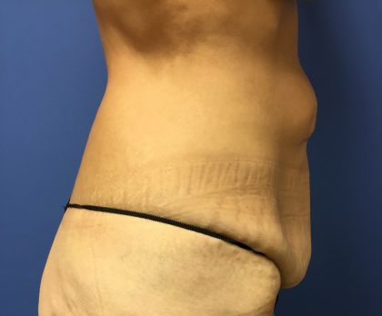 Tummy Tuck Before & After Patient #2629