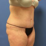 Tummy Tuck Before & After Patient #2634