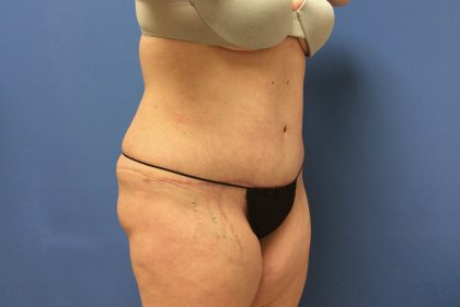 Tummy Tuck Before & After Patient #2634
