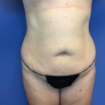 Tummy Tuck Before & After Patient #2634