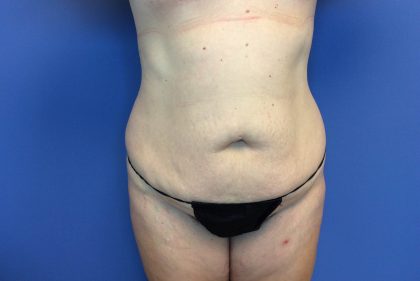 Tummy Tuck Before & After Patient #2634