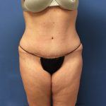 Tummy Tuck Before & After Patient #2634
