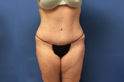 Tummy Tuck Before & After Patient #2634