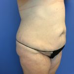 Tummy Tuck Before & After Patient #2634