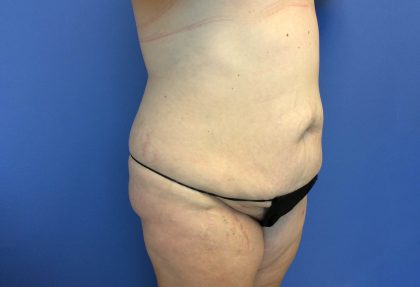 Tummy Tuck Before & After Patient #2634