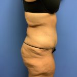 Tummy Tuck Before & After Patient #2639