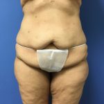 Tummy Tuck Before & After Patient #2639