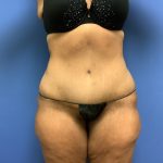 Tummy Tuck Before & After Patient #2639