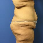 Tummy Tuck Before & After Patient #2639