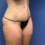 Tummy Tuck Before & After Patient #2644