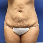 Tummy Tuck Before & After Patient #2644