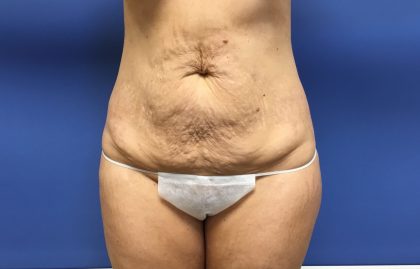 Tummy Tuck Before & After Patient #2644