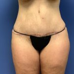 Tummy Tuck Before & After Patient #2644