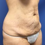 Tummy Tuck Before & After Patient #2644