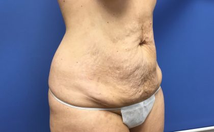 Tummy Tuck Before & After Patient #2644